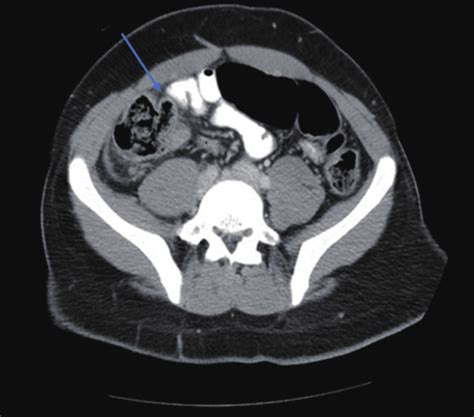 Abdominal Ct An Axial View Demonstrated A Mild Amount Of Fluid In The