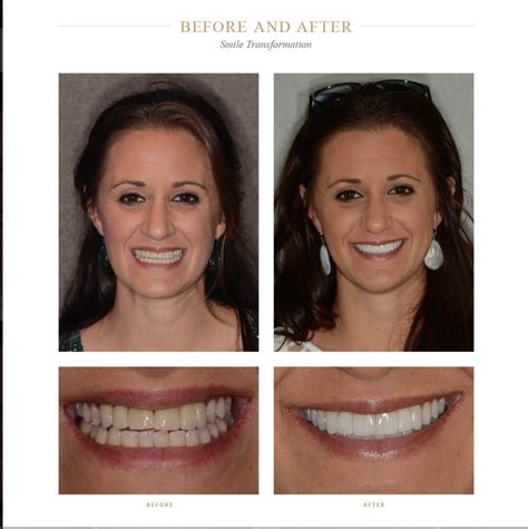 Dental Before And After Photos Brea Fullerton Dental Before And After