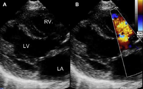 E 2d Echocardiography With Parasternal Long Axis View Showing The