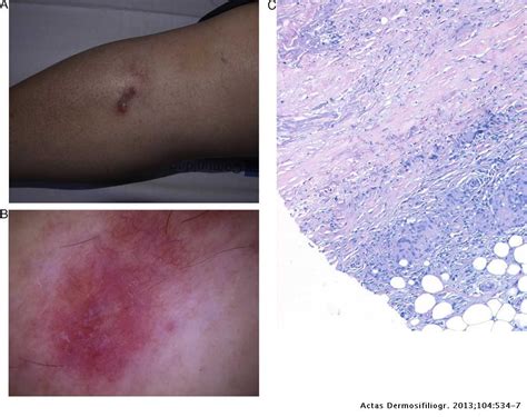 Dermoscopy Of Necrobiosis Lipoidica Actas Dermo Sifiliográficas