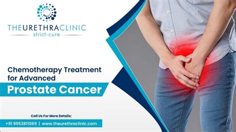 Chemotherapy Treatment For Advanced Prostate Cancer The Urethra Clinic