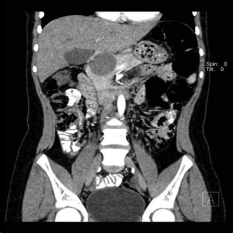 Frantz Tumor Resection Central Pancreatectomy With Roux En Y And