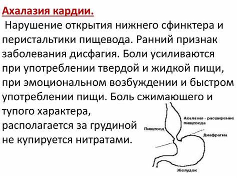 Недостаточность розетки кардии диета Эзофагит: недостаточность кардии - варианты лечения, диеты и отзывы Эзофагит: недостаточность кардии - варианты лечения, диеты и отзывы Недостаточность розетки кардии диета