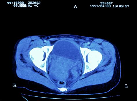 Cervical Cancer Ct Scan Photograph By Science Photo Library Pixels