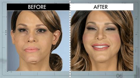 Botched Plastic Surgery Before And After Body