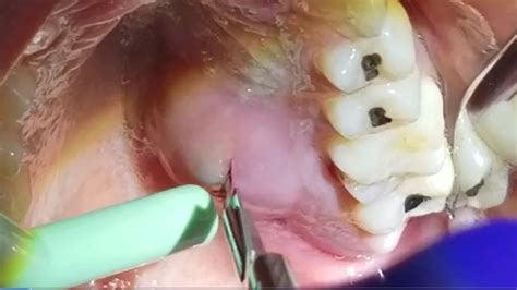Gum Abscess All About Dental Abscesses Tooth Abscesses And Drainage Dental Clinic