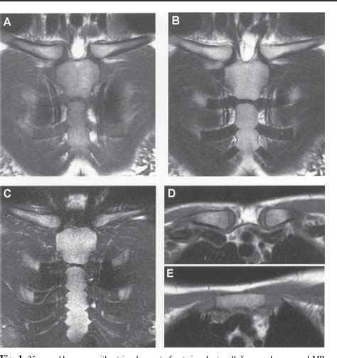 Figure From Magnetic Resonance Imaging In Tietze S Syndrome