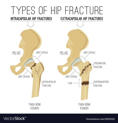 Types Of Hip Fracture Royalty Free Vector Image