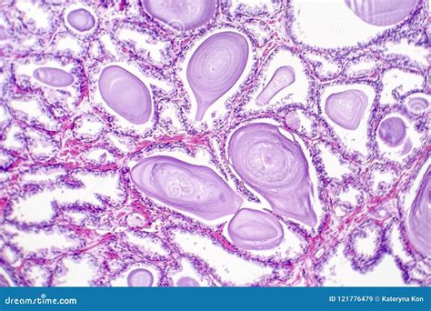 Hiperplasia Prostática Benigna Imagem de Stock Imagem de histologia celular