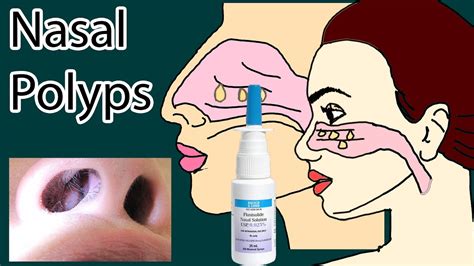 Swollen Nasal Polyps