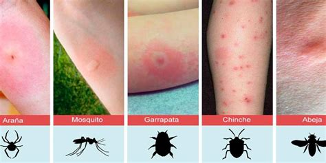 7 Alergia A Las Picaduras De Insectos Nuestroclima