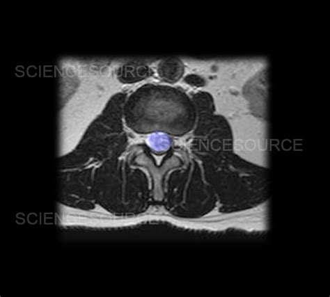 Mri Of Lumbar Schwannoma Stock Image Science Source Images