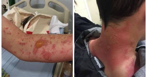 Teenagers Suffer Severe Burns From Toxic Hogweed Plant Manchester Evening News