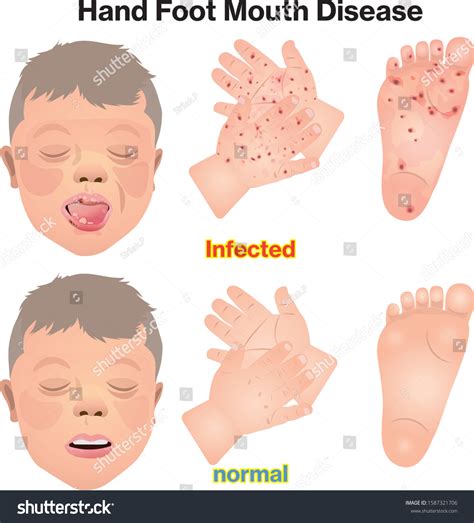 Hand Foot Mouth Disease Contagious Diseases Stock Vector Royalty Free