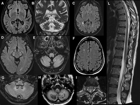 A Summary Of The Main Mri Findings In Ctx A Axial Flair Image Shows