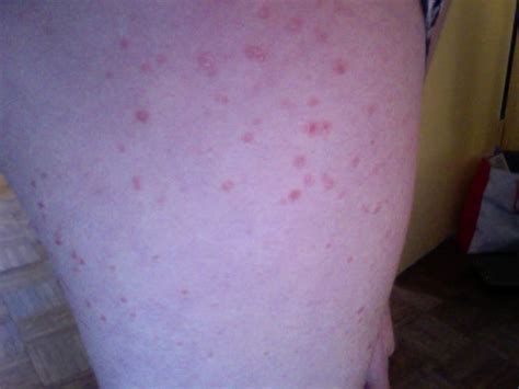 I Have A Rash That Began On My Upper Thighs And Has Spread