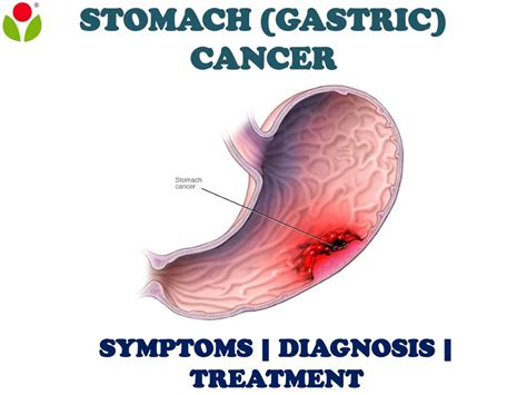 Ppt Stomach Gastric Cancer Overview Of Symptoms Diagnosis And Treatment Powerpoint