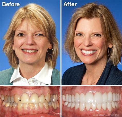 Cosmetic Dentistry Smile By The Station Dentistry Seattle Washington