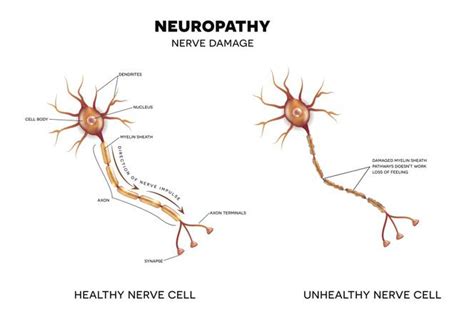 Neuropatia Rodzaje Przyczyny Objawy Leczenie Poradnikzdrowiepl Cloobx