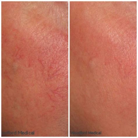 Facial Redness And Rosacea Woodford Medical