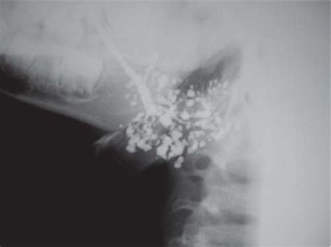 The Neck The Salivary Glands Radiology Key