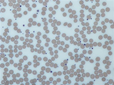 Therapeutics Platelet Coagulopathy Fixes With Itp Ttp And Dic