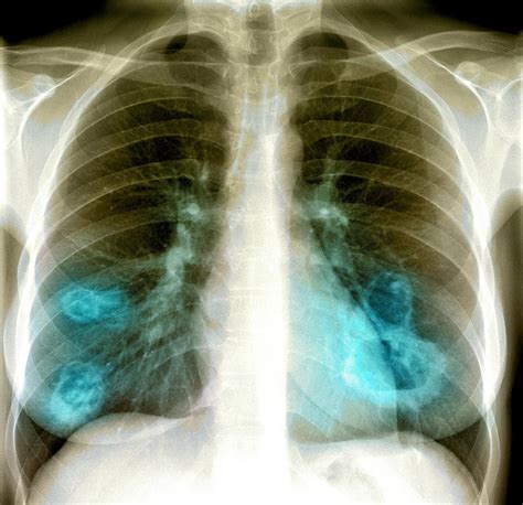 Lung Lesions X Ray Photograph By Du Cane Medical Imaging Ltd Fine