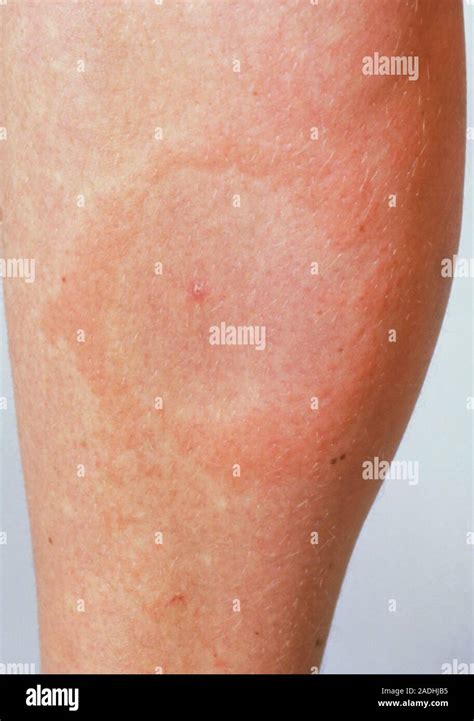 Lyme Disease Rash A Circular Rash On A Female Patients Lower Left Leg