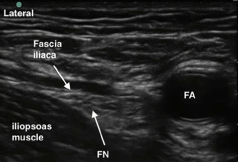 Femoral Triangle Ultrasound