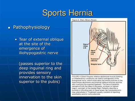 Sports Hernia Athletic Pubalgia Sports Hernia 1 Youtube Again