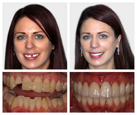 Implantes Dentales Antes Y Despu S Implantesdentales