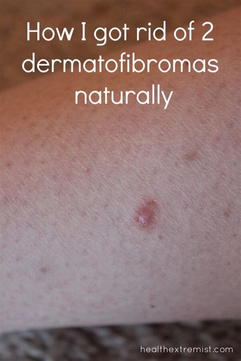 How To Get Rid Of A Dermatofibroma Naturally Skin Bumps Loose Skin Skin