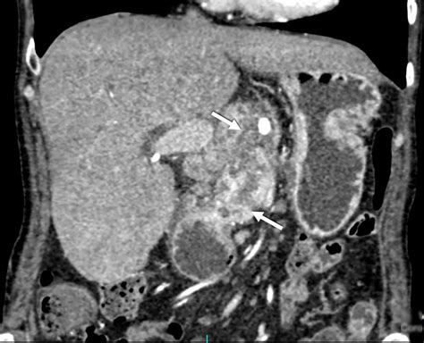 Coronal Section Contrast Enhanced Abdominal Computed Tomography Showing