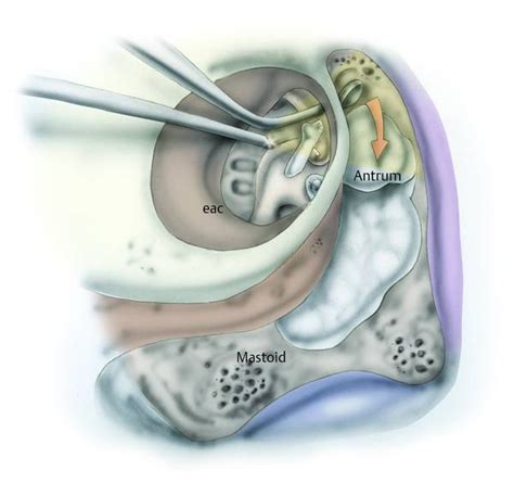 Combined Endoscopicmicroscopic Middle Ear Surgery For Cholesteatoma