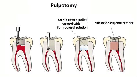 What Is Pulpotomy News Dentagama