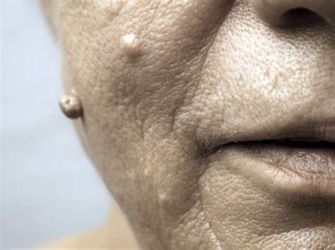 Facial Warts And How To Remove Them Facial Warts Face Warts Warts