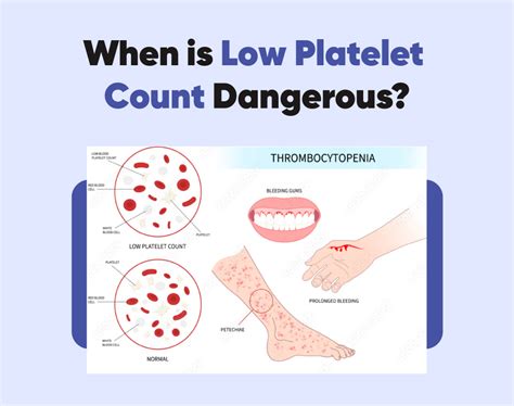 When Is Low Platelet Count Dangerous