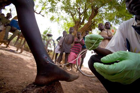 Guinea Worm Disease Could Soon Become The Second Human Disease To Be