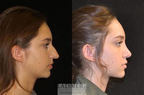 Rhinoplasty Nose Job Before And After Pictures Case Denver Co Ladner Facial Plastic
