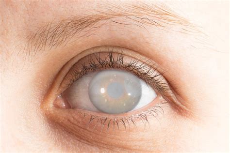 How Do Cataracts Affect Vision Invision Eye Care Ophthalmologists