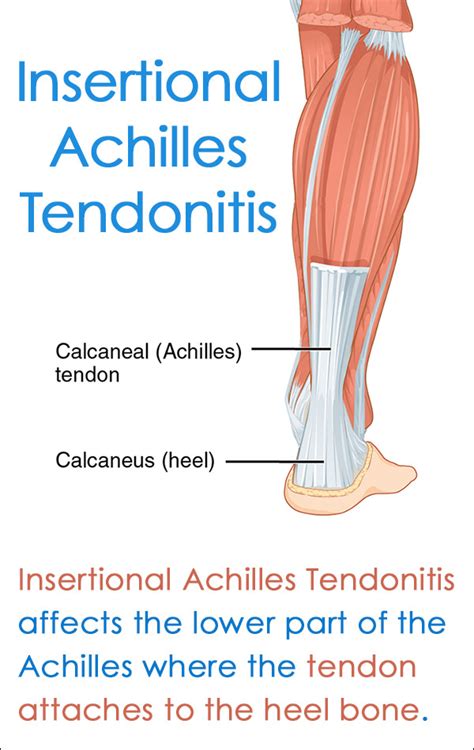 Swelling that is present throughout the day that worsens with activity. Insertional Achilles Tendonitis Treatment and Symptoms ...