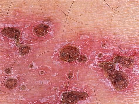 Is It Shingles 7 Myths About Painful Illness Graphic Images Cbs News