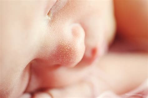 A Summary Of Some Common Skin Rashes In Babies Extramedia