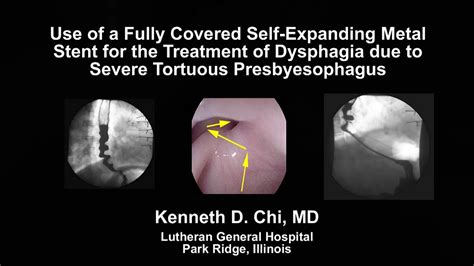 Use Of A Fully Covered Metal Stent For The Treatment Of Dysphagia Due