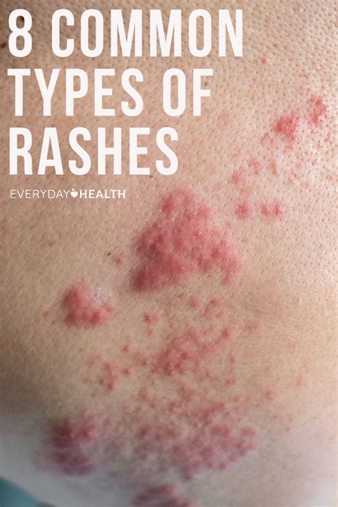 Rash The Most Common Types Of Skin Rashes Treatment Hot Sex Picture