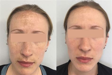 What Is Hyperpigmentation And How Can It Be Treated — Lumiere Medispa