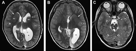 Figure 1 From Cerebral Palsy And Seizures In A Child With Tubulinopathy