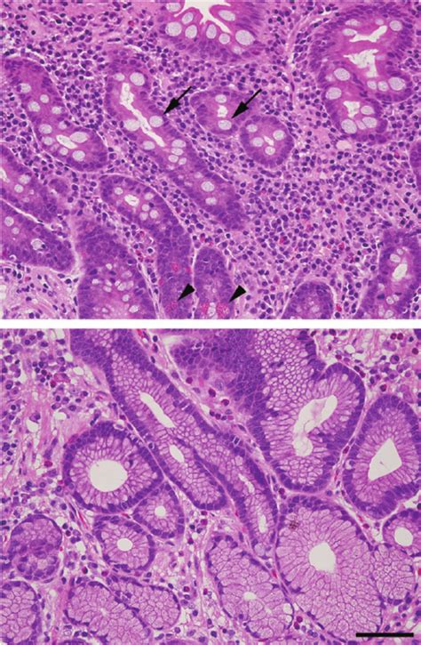Histology Of Human Tissue Show Gastric Mucosa Intestinal Metaplasia As Sexiz Pix