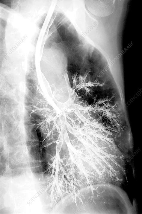 Bronchial Tree Of The Lung X Ray Stock Image C007