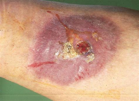 Management Of Venous Ulcer Disease The Bmj